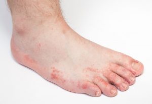 Foot infections