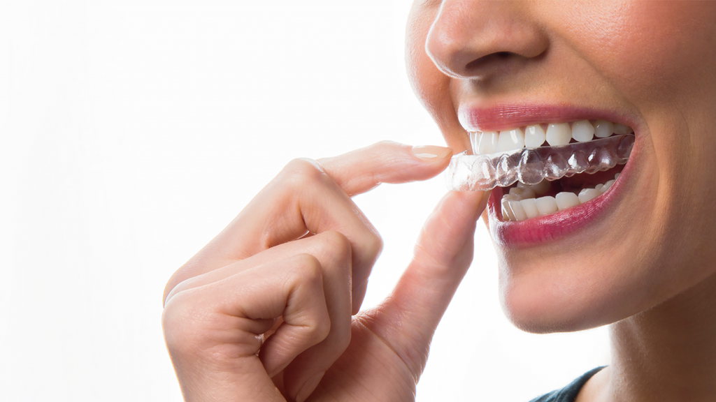 clear aligners for teeth